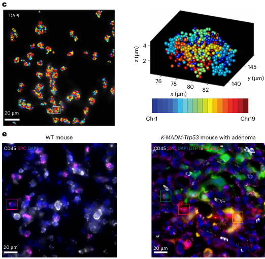Single-cell 3D Genome Atlases Describing Cancer Progression Reveal Stage-specific Alterations and Novel Biomarkers